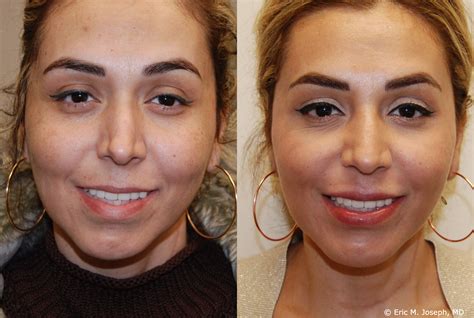 silikon 1000 before and after.